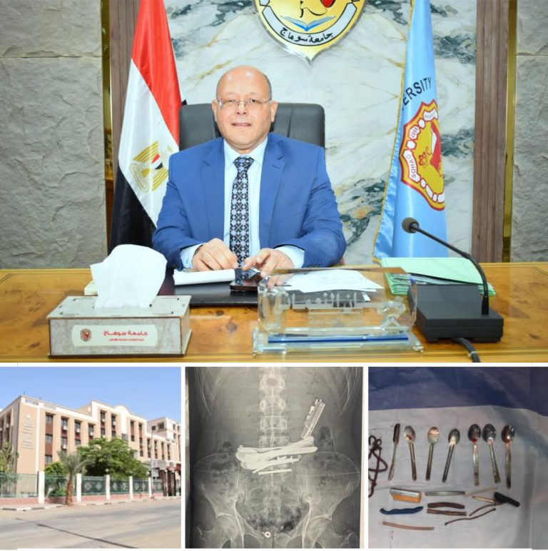 فى جراحة نادرة ..مستشفى سوهاج الجامعي ينجح فى إنقاذ مريض ابتلع أجسامًا معدنية حادة
