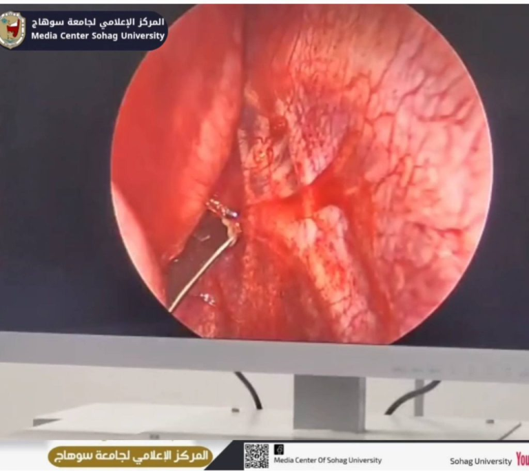 بإنقاذ أشبه بالمعجزة.. مستشفيات سوهاج الجامعية تنجح في إنقاذ طفل تعرص لطعنة نافذة بالقلب باستخدام منظار الصدر الجراحي