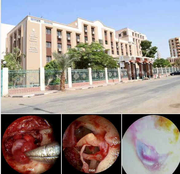 خطوة جديدة في جراحات الصعيد: أطباء سوهاج الجامعي ينجحون في استئصال ورم بالأذن الوسطى بالمنظار**