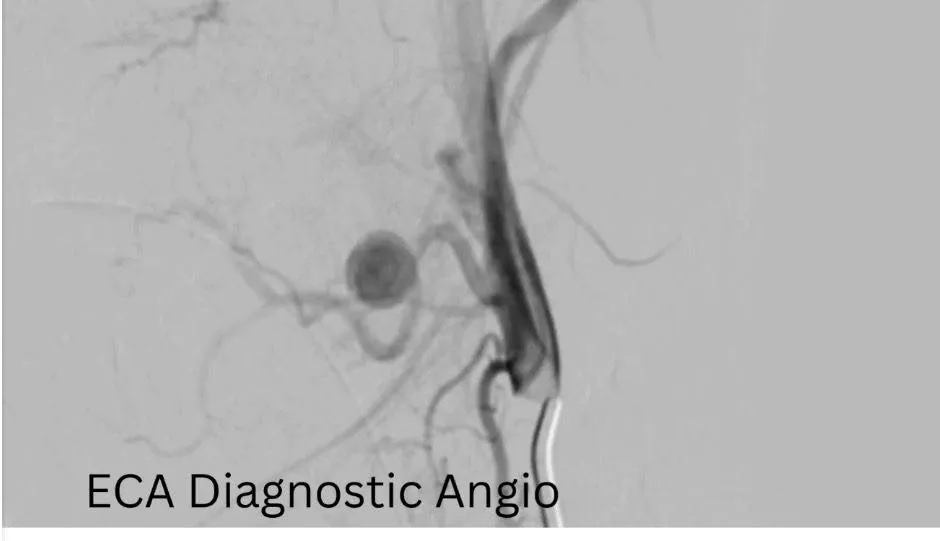 بعد مضاعفات خطيرة لاستئصال اللوز.. فريق طبي بمستشفيات سوهاج الجامعية ينقذ حياه طفله وينجح في غلق تمدد شرياني نازف دون جراحة
